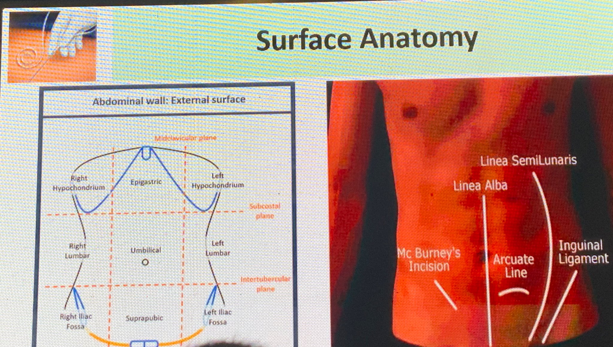 Arcuate Line Of Rectus Sheath