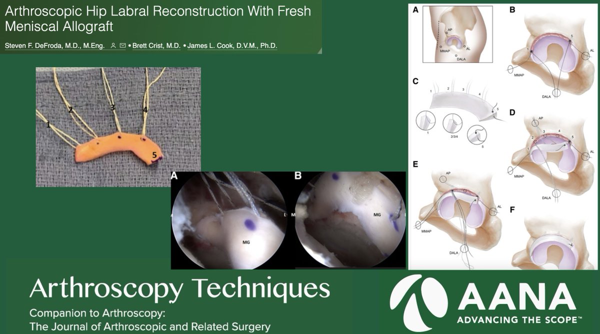 ArthroscopyJ's tweet image. #Arthroscopic #Hip #Labrum #Reconstruction with #Meniscus #Allograft... ow.ly/f90P50P231N
Video: ow.ly/CztG50P231P
