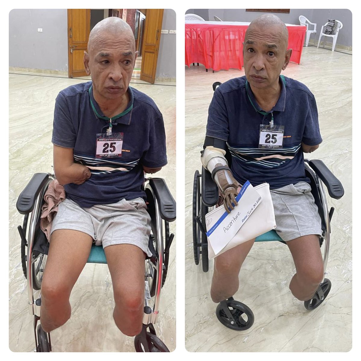 rtnmohan's tweet photo. Medical Amputation of both the lower limbs &amp; upper limbs.We created Hope to this person by providing free below elbow LN-4 Prosthetic Hand by our Team in Ahmedabad Yesterday. https://t.co/afLy6SfaBT