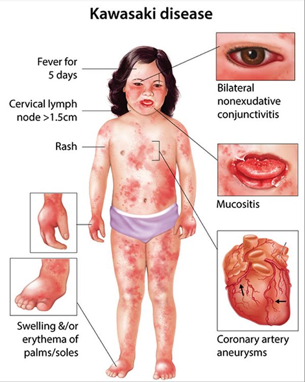 walinjom's tweet photo. Kawasaki disease

Management:

high-dose aspirin

intravenous immunoglobulin

echocardiogram ?  coronary artery aneurysms https://t.co/L53EhKXnHE