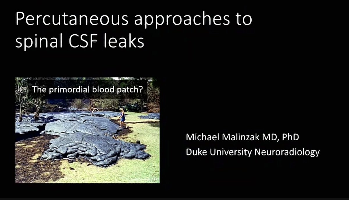 spinalCSFleak's tweet photo. Day two of #SIH2023 Intracranial Hypotension Conference kicks off with presentations on Current and Evolving Treatment Approaches. First up, “Percutaneous approaches to spinal CSF leaks,” by Dr. Michael Malinzak https://t.co/EMJo2VKdnA
