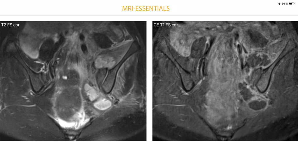 EssentialsMri's tweet photo. Bacterial sacroiliitis with diffuse contrast enhancement around the left sacroiliac joint and extensive abscesses. Unremarkable right SIJ. Even without abscess formation, infection would have to be suspected because of the asymmetry.
#mskrad #orthotwitter #radres #radiology https://t.co/CJG3HtoW5m