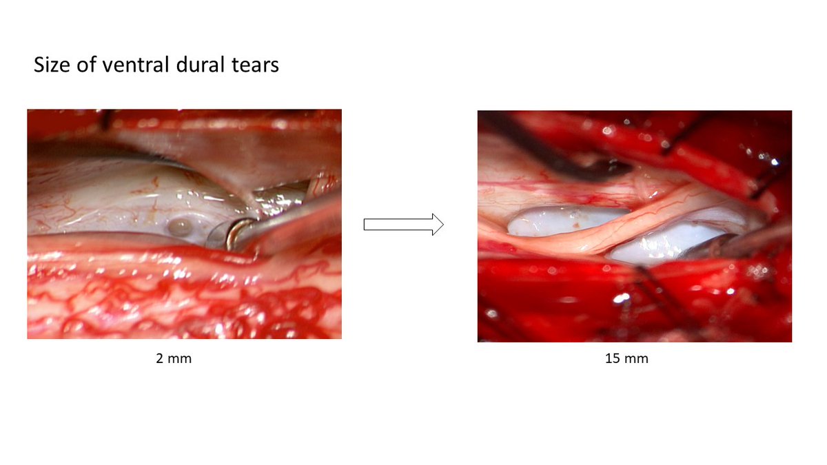 ConnieDelineMD's tweet image. Wide range of sizes of ventral dural tears in the experience of @WouterSchievink #SIH2023 #spinalCSFleak