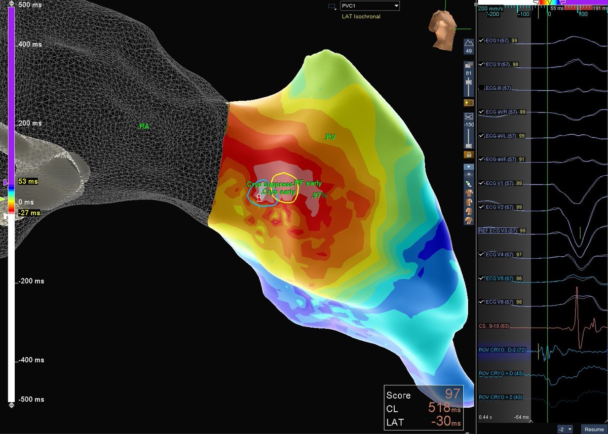 Hapa_EP's tweet image. Three back to back PVC cases in 1 day in 1 lab, a personal record! 😁 1st one was classic ATV3, originating from R/L ILT. 2nd one was TA free wall and needed cryo for better stability. 3rd one was mid-myocardial and required RF from both PS RVOT and RCC to finish it off. #EPeeps