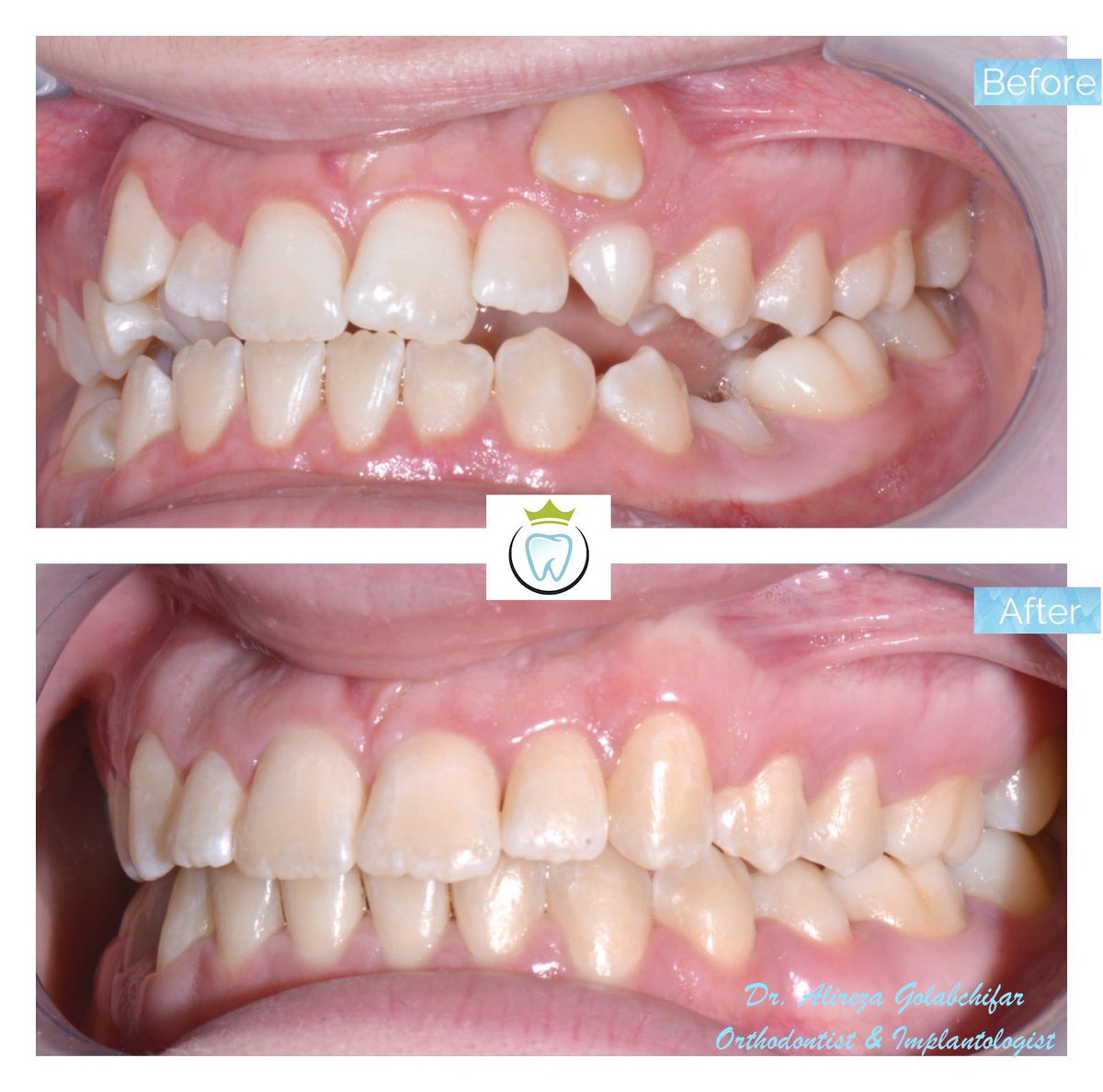 dentistry_king's tweet photo. With the use of upper and lower braces were able to correct this bite and alleviate class III relationship.
Resulting in a beautiful smile!!

#orthodontics #braces #smile #smiletransformation #cosmeticdentistry #orthosmile #orthosmiletoronto #dentistry https://t.co/qOosu0ARfq