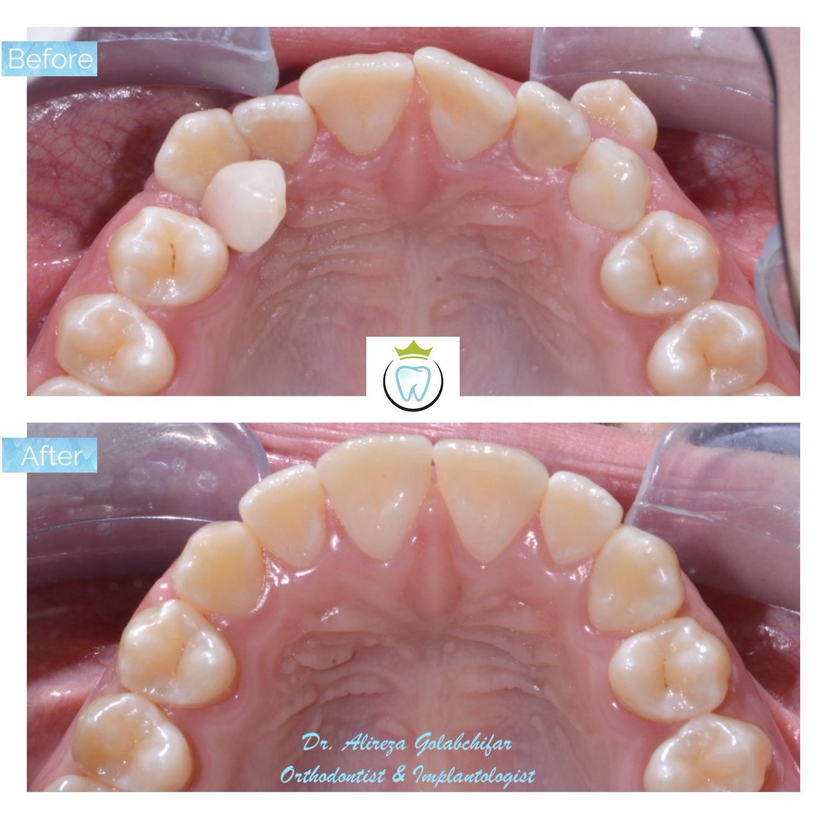 dentistry_king's tweet photo. With the use of upper and lower braces were able to correct this bite and alleviate class III relationship.
Resulting in a beautiful smile!!

#orthodontics #braces #smile #smiletransformation #cosmeticdentistry #orthosmile #orthosmiletoronto #dentistry https://t.co/qOosu0ARfq