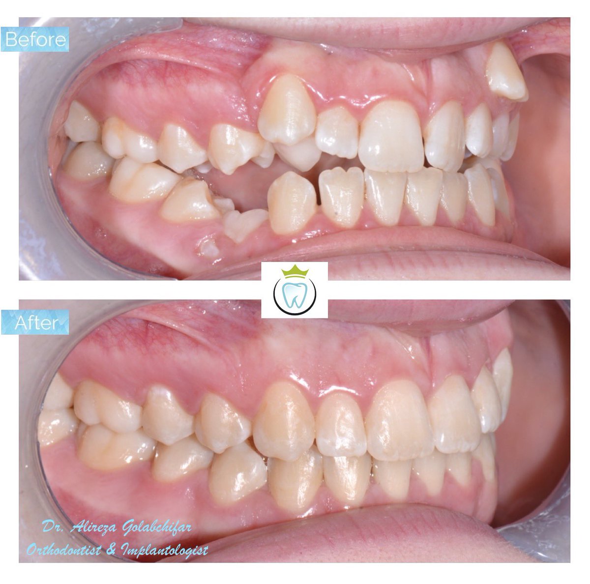 dentistry_king's tweet photo. With the use of upper and lower braces were able to correct this bite and alleviate class III relationship.
Resulting in a beautiful smile!!

#orthodontics #braces #smile #smiletransformation #cosmeticdentistry #orthosmile #orthosmiletoronto #dentistry https://t.co/qOosu0ARfq