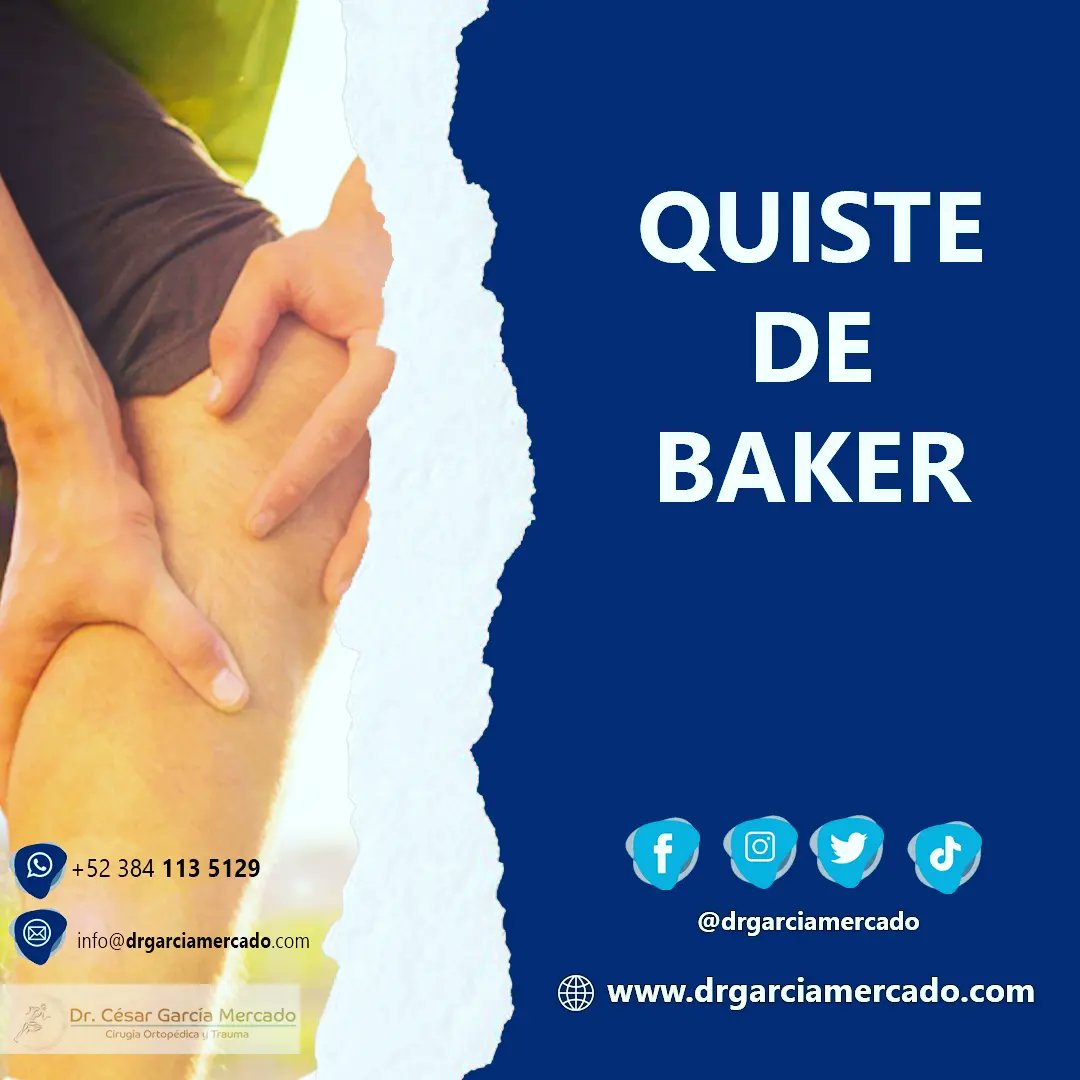 drgarciamercado's tweet photo. 🚨 QUISTE DE BAKER. Cómo identificarlo?
🥼 Dr. César García Mercado- Cirugía Ortopédica y Trauma 🩺🏥
📲 384 113 5129
🌐 https://t.co/rCeYB19b2Q
#traumatologia #traumatologo #fracturas
#ortopedia #ortopedista #ortopediainfantil #orthopedics #lesiones #quistedebaker https://t.co/ctivRqjSFo