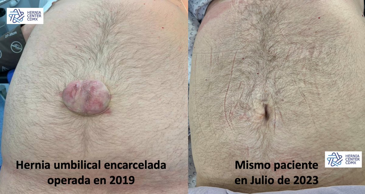 Cirugía Mínimamente Invasiva no tiene por qué ser sinónimo de laparoscopía o robot. Éste es un claro ejemplo de ello. Hernia umbilical operada hace 4 años con anestesia local y sedación; utilizamos malla y él está feliz con el resultado.  
Consulte a los expertos.