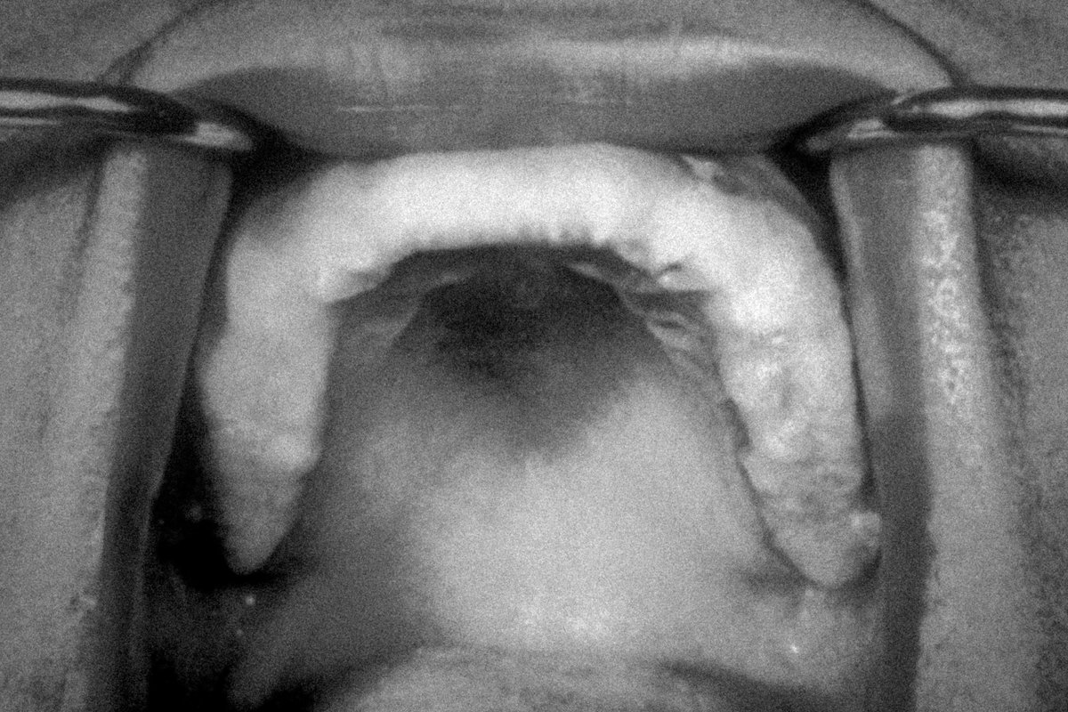 Valdevia_Art's tweet photo. Monodontia, commonly known as "Tombstone teeth", is a rare condition where adult teeth start growing, fusing into a single block. Growth of the tooth may continue, requiring constant filing. No cure exists apart from complete excision of the dental arch. https://t.co/ApGHUroByb