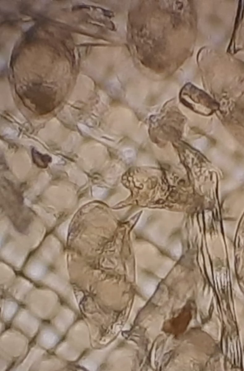 Another unusual finding is eggs of S mansoni in several participants’ urine - together with other ova - a pattern of mixed infections that seems to repeat from last year’s inspection.