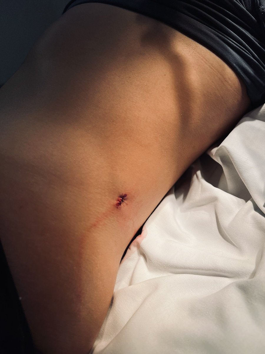 Finalmente hoy me podrán quitar los puntos después de 10 días 🤩 

Durante un entrenamiento previo al CS de Sudáfrica fui atropellada accidentalmente por otro competidor,  clavándome su quilla y provocándome un corte pequeño pero de una gran profundidad 🤕