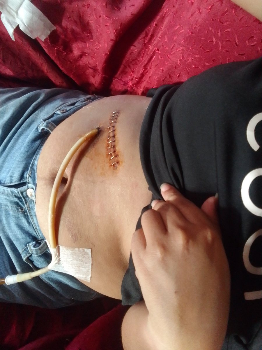 Hyacinthbaroy's tweet photo. My wife had a gall bladder surgery last month. And up until now she is still in medication and stuffs. https://t.co/djDUHXkwfC
