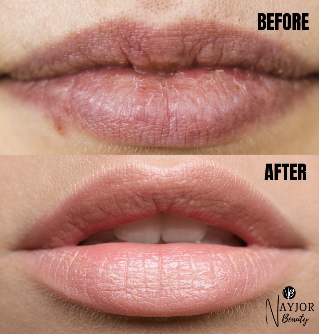 𝐁𝐞𝐟𝐨𝐫𝐞 & 𝐀𝐟𝐭𝐞𝐫.👄

nayjorbeauty.com

#beforeandafter #mondaymotivation #drylips #crackedlips #smokers #smokerslines #smokerslips #drylipsremedy #lipcare #lipcareroutine #lipcareproducts #lipscrubs #lipmask #lipbalm #beautyroutine #blackowned #results