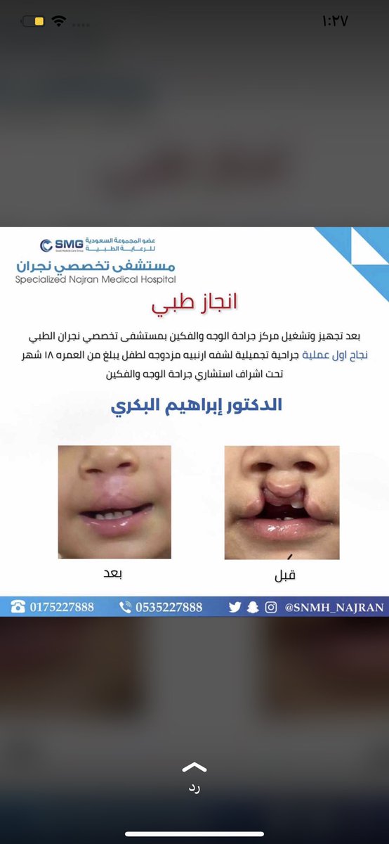 #نجران_الانᅠ الإخلاص صفة إنسانية جميلة عندما يبلغها الإنسان بمشاعره وعمله فإنه يصل لأحد مراحل بلوغ النفس البشرية لفضائلها وهنا مثال في عمل وانجاز طبي للدكتور إبراهيم البكري يزرع البسمه على وجه طفله بعمل طبي رائع مليئ بالأنسانيه والإخلاص . الله يزيد المنطقه والوطن بأمثاله 🇸🇦🤍