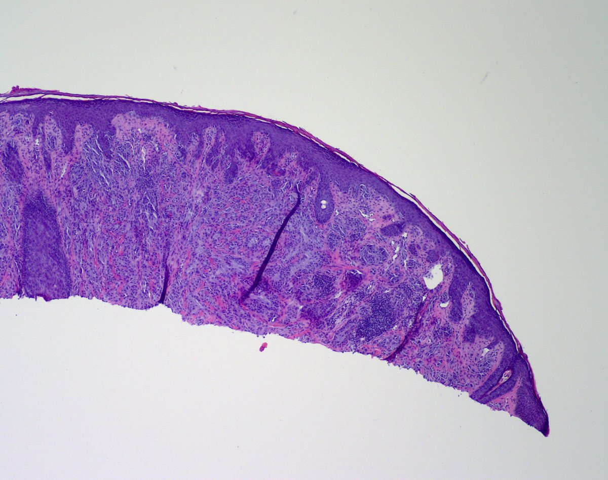 1/2.
Teen♂️Face
Looks like a Spitz nevus to me. P16 uniformly retained.
Question: Do you give an excision recommendation on your report? If yes, how many millimeters, or just generic excise NOS?
<a href="/mccalmo/">Tim McCalmont</a> <a href="/HENRYY_MD/">Henry YANG</a> <a href="/melanopath/">Arnaud de la Fouchardiere MD, PhD</a> <a href="/DiegoMoralesN/">Diego Morales, MD</a>
<a href="/ChristineJKoMD/">Christine J. Ko, MD</a> <a href="/STEVENKOLKERMD/">Steven</a>