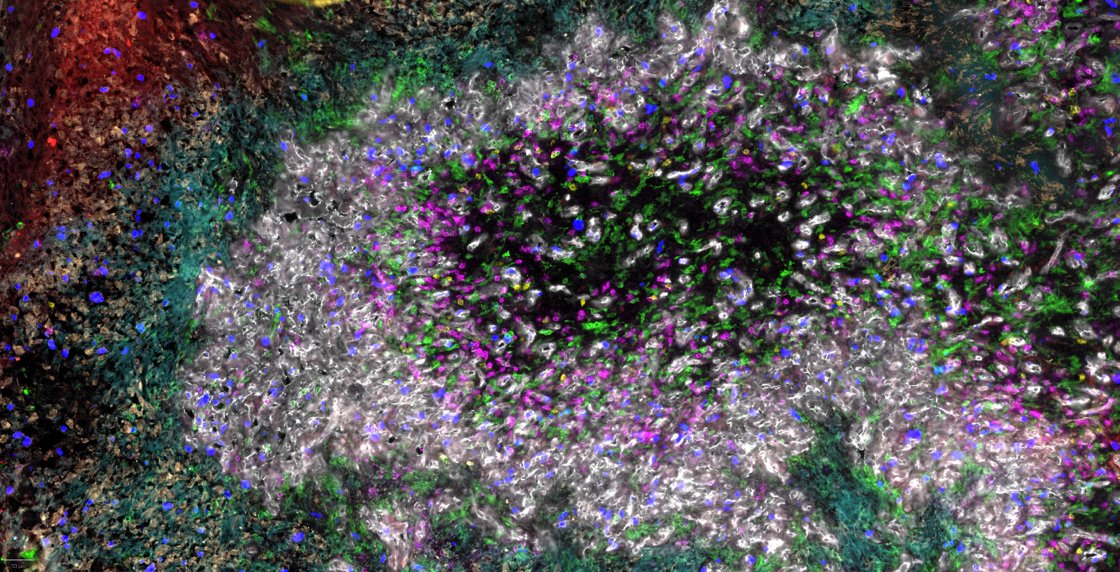 We’re excited to share our preprint on spatial organization in glioblastoma: doi.org/10.1101/2023.0…. We combine spatial transcriptomics (Visium) and proteomics (CODEX) to reveal a five-layer organization of cellular states and highlight a role of hypoxia as tissue organizer. 1/
