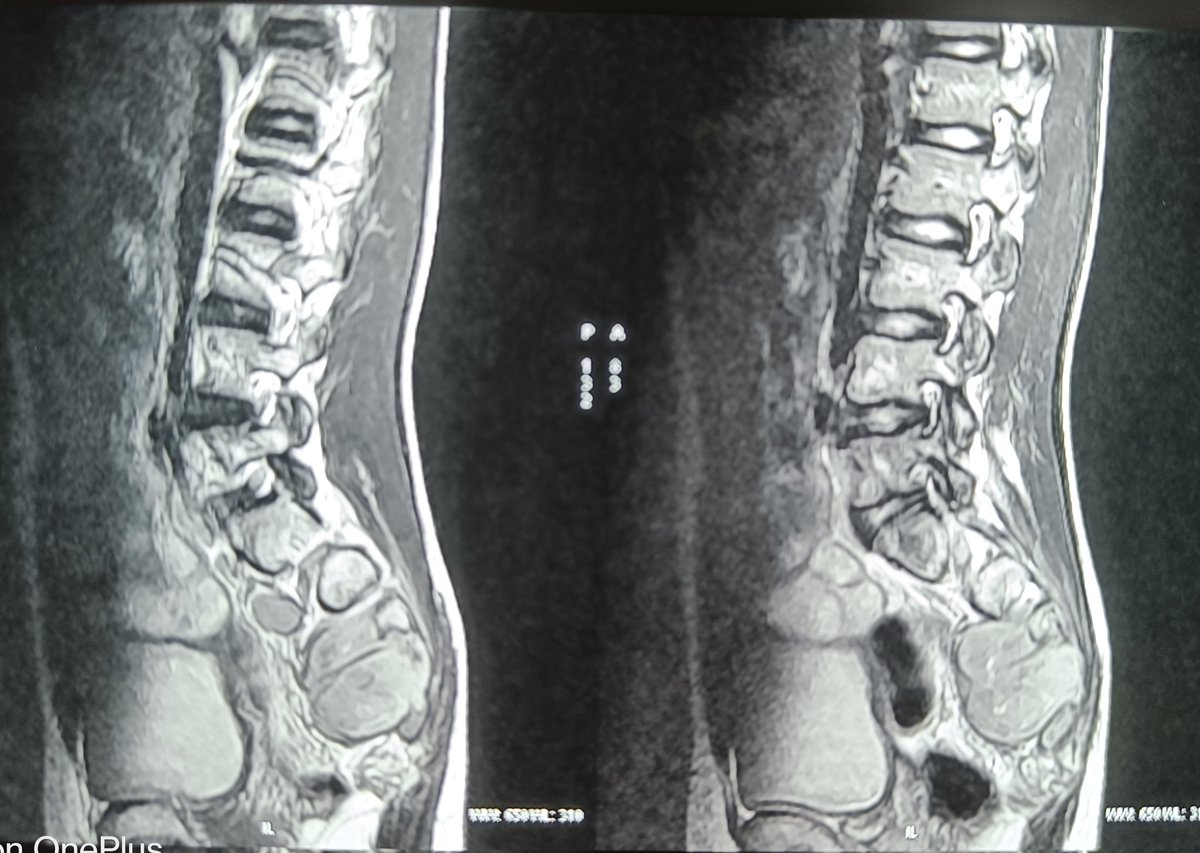 Pritampedhemonc's tweet photo. 14 y old boy with low back pain * 4 months. Bilateral lower limb weakness, loss of bladder sensation x 2 weeks. 
Differentials? 
#pediatricOncology
#ChildhoodCancer
#CordCompression
#medtwitter https://t.co/bM8BzFi7Mz