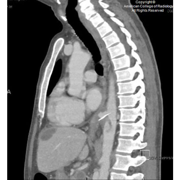 American College of Radiology on Twitter "A 60yearold man with no