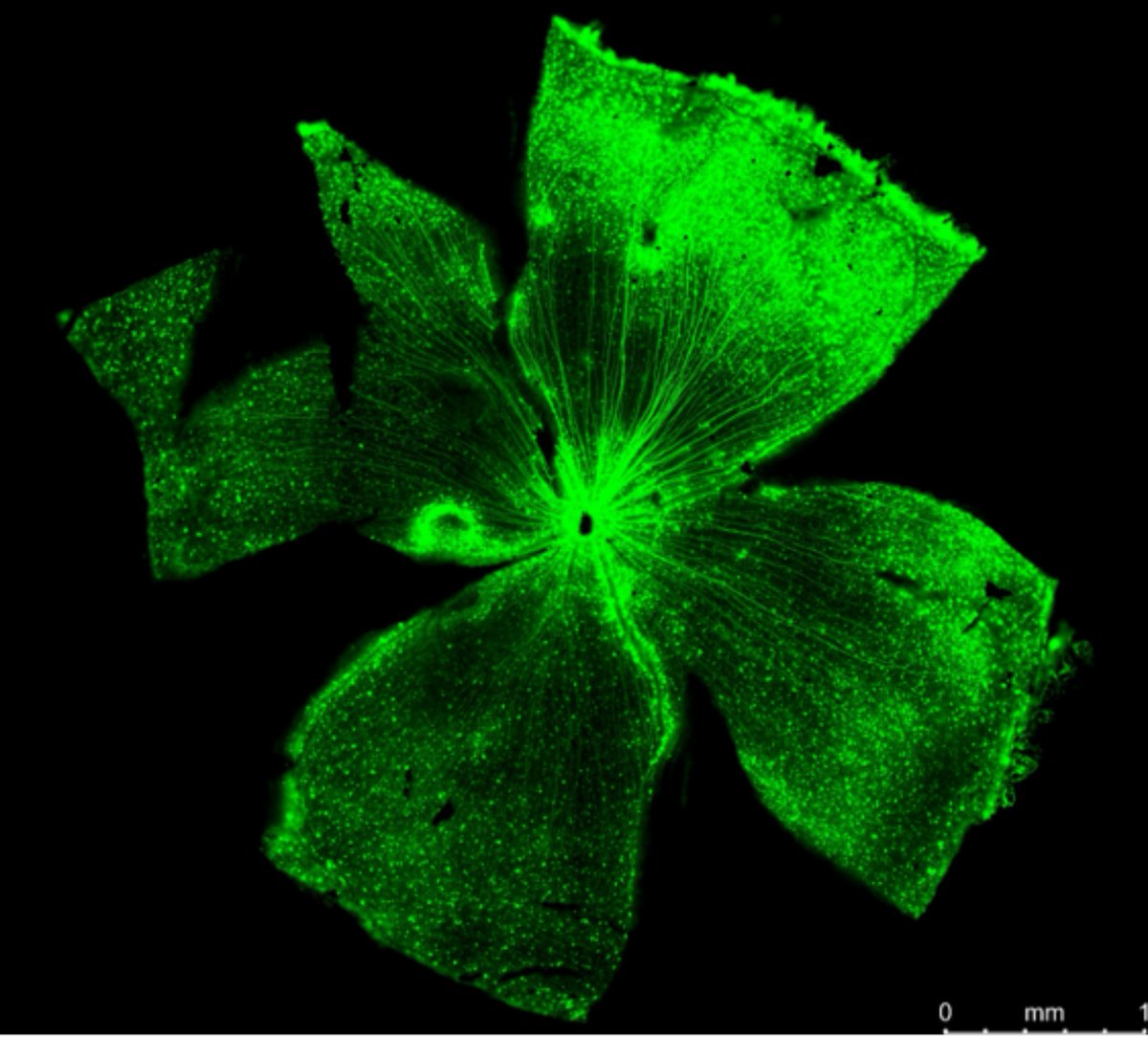Gene Therapy (@genetherapy_sn) on Twitter photo Bilateral intravitreal injection of triple phosphodegron mutant #AAV2 capsid is associated with increased local and systemic immune activation
#OpenAccess #GTArticle ➡️nature.com/articles/s4143…
🧪: <a href="/Cambridge_Uni/">Cambridge University</a>, <a href="/GSTTnhs/">Guy's and St Thomas'</a>, <a href="/Moorfields/">Moorfields Eye Hospital NHS Foundation Trust</a>, <a href="/UCLeye/">UCL Institute of Ophthalmology</a> & <a href="/UniMelb/">University of Melbourne</a>
📸: Retinal wholemount Bilateral intravitreal injection of triple phosphodegron mutant #AAV2 capsid is associated with increased local and systemic immune activation
#OpenAccess #GTArticle ➡️nature.com/articles/s4143…
🧪: <a href="/Cambridge_Uni/">Cambridge University</a>, <a href="/GSTTnhs/">Guy's and St Thomas'</a>, <a href="/Moorfields/">Moorfields Eye Hospital NHS Foundation Trust</a>, <a href="/UCLeye/">UCL Institute of Ophthalmology</a> & <a href="/UniMelb/">University of Melbourne</a>
📸: Retinal wholemount