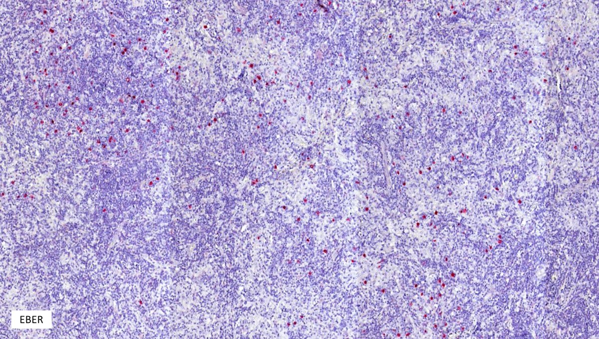 Nodal TFH cell lymphoma, follicular-type➡️ If a lymph node looks like it's involved by NLPHL or FL, but the aberrant population has a T-cell phenotype, think about
 this entity #hemepath #lymsm #PathTwitter #medtwitter