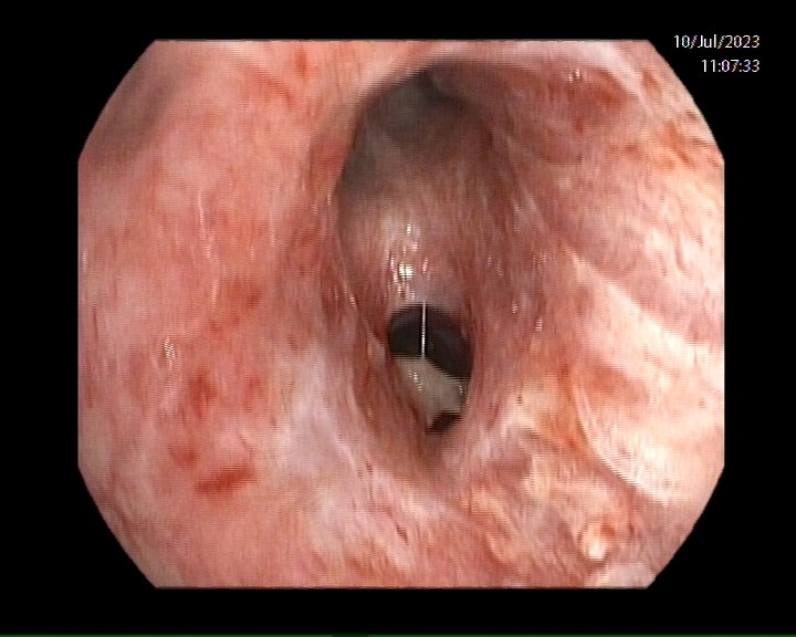 NeumoIntervHURS's tweet photo. Una de las complicaciones más frecuentes tras el trasplante pulmonar son las estenosis bronquiales. 
Hoy, estenosis de bronquio intermediario en paciente trasplantado pulmonar hace 4 meses. Tratamos endoscópicamente mediante dilatación con balón. @HUReinaSofia @ONT_esp https://t.co/KMV3DroH5K
