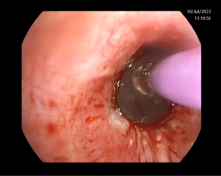 NeumoIntervHURS's tweet photo. Una de las complicaciones más frecuentes tras el trasplante pulmonar son las estenosis bronquiales. 
Hoy, estenosis de bronquio intermediario en paciente trasplantado pulmonar hace 4 meses. Tratamos endoscópicamente mediante dilatación con balón. @HUReinaSofia @ONT_esp https://t.co/KMV3DroH5K