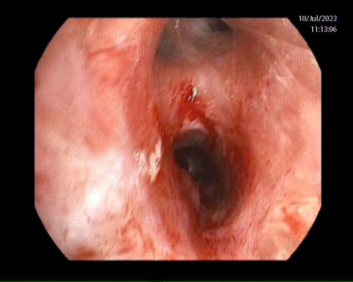 NeumoIntervHURS's tweet photo. Una de las complicaciones más frecuentes tras el trasplante pulmonar son las estenosis bronquiales. 
Hoy, estenosis de bronquio intermediario en paciente trasplantado pulmonar hace 4 meses. Tratamos endoscópicamente mediante dilatación con balón. @HUReinaSofia @ONT_esp https://t.co/KMV3DroH5K
