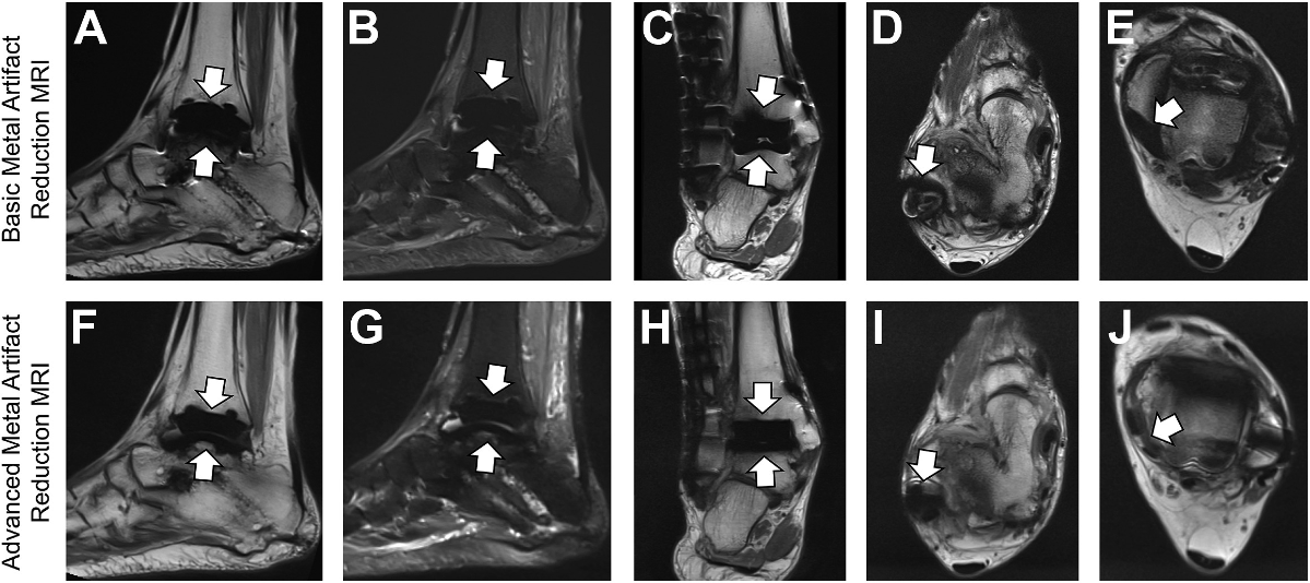 🩻🦴🔥FREE PDF🔥🦴🩻 authors.elsevier.com/a/1hMQG3sQgGZQ… 👉limited dl-link👈Fritz J, Rashidi A, de Cesar Netto C. Magnetic Resonance Imaging of Total Ankle Arthroplasty: State-of-The-Art Assessment. Foot and Ankle Clinics. @nyu_mskrad @Dr_deCesarNetto @ElsevierConnect @AliRashidi68