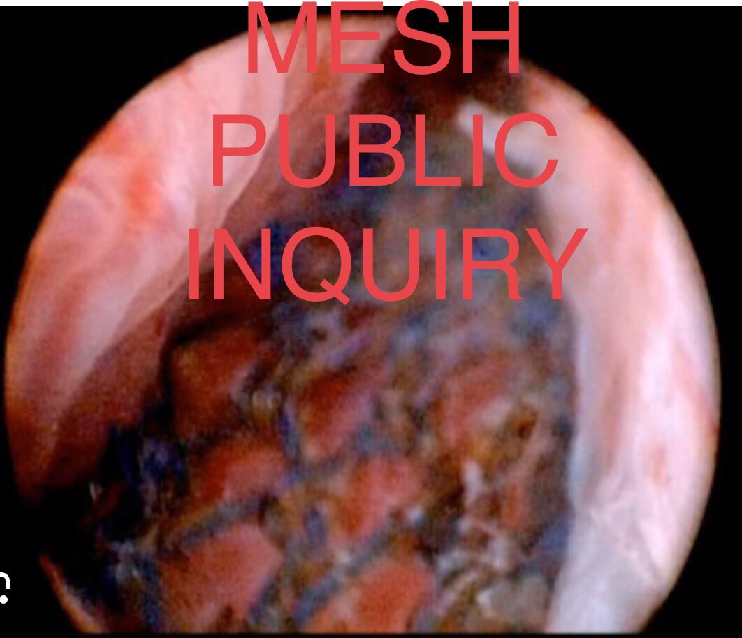 TVT #mesh caused ‘avoidable harm’ & a government apology was given Mesh removal surgery will be identifying wrong placement further cause catastrophic harm Blind procedure performed Wrong placement cavalier practice PUBLIC INQUIRY necessary @mariacaulfield @DrBruceKeogh
