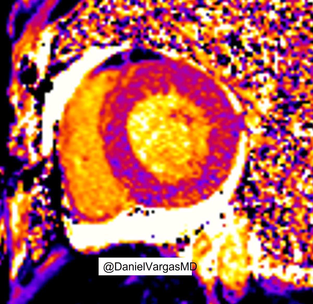 DanielVargasMD's tweet photo. 🫀 Good example of Lupus Myocarditis

Diffusely thickened LV
⬆️ T1 (1100-1150 ms) top row
⬆️ T2 (55-68 ms) bottom row
Pericardial effusion

#whyCMR #radiology #FOAMed
@KateHanneman @onco_cardiology @purviparwani @HsiaoMDPhD  @ecocardio_cl @danilorenzatti @kirschj @JordiBroncano https://t.co/NFnpV9vyxO