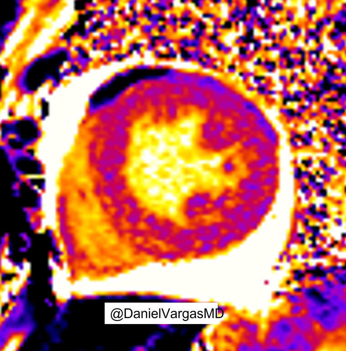 Daniel Vargas, MD (@danielvargasmd) on Twitter photo 🫀 Good example of Lupus Myocarditis
Diffusely thickened LV
⬆️ T1 (1100-1150 ms) top row
⬆️ T2 (55-68 ms) bottom row
Pericardial effusion
#whyCMR #radiology #FOAMed
<a href="/KateHanneman/">Kate Hanneman</a> <a href="/onco_cardiology/">Juan Lopez-Mattei, MD</a> <a href="/purviparwani/">Dr. Purvi Parwani</a> <a href="/HsiaoMDPhD/">Albert Hsiao 蕭, MD, PhD, FNASCI, FSCMR 🐳</a> <a href="/ecocardio_cl/">Julián Vega Adauy</a> <a href="/danilorenzatti/">Daniel Lorenzatti, MD.</a> <a href="/kirschj/">Jacobo Kirsch, MD, MBA, FACR</a> <a href="/JordiBroncano/">Jordi Broncano</a> 🫀 Good example of Lupus Myocarditis
Diffusely thickened LV
⬆️ T1 (1100-1150 ms) top row
⬆️ T2 (55-68 ms) bottom row
Pericardial effusion
#whyCMR #radiology #FOAMed
<a href="/KateHanneman/">Kate Hanneman</a> <a href="/onco_cardiology/">Juan Lopez-Mattei, MD</a> <a href="/purviparwani/">Dr. Purvi Parwani</a> <a href="/HsiaoMDPhD/">Albert Hsiao 蕭, MD, PhD, FNASCI, FSCMR 🐳</a> <a href="/ecocardio_cl/">Julián Vega Adauy</a> <a href="/danilorenzatti/">Daniel Lorenzatti, MD.</a> <a href="/kirschj/">Jacobo Kirsch, MD, MBA, FACR</a> <a href="/JordiBroncano/">Jordi Broncano</a>