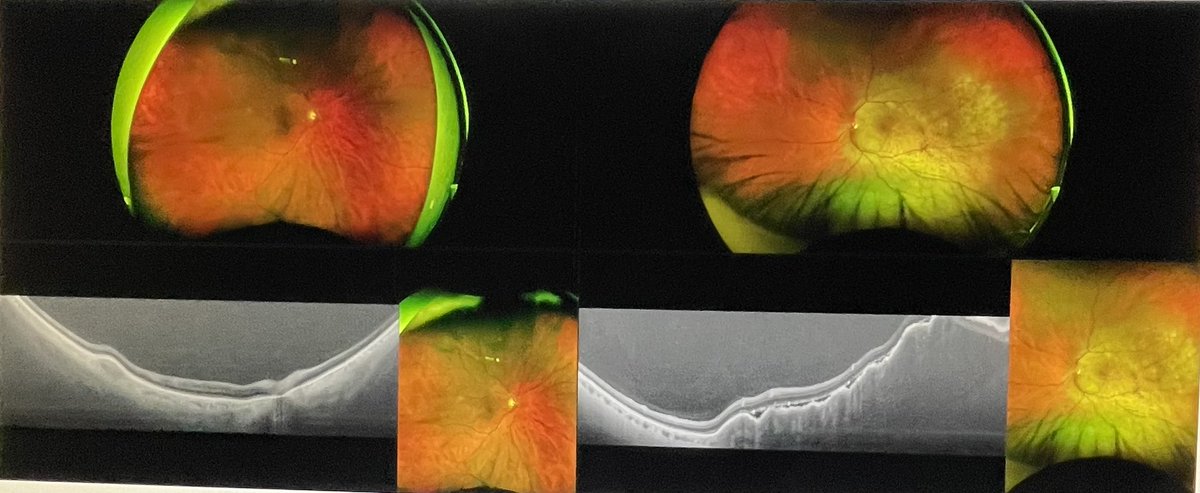 DrAlfredoAdan's tweet photo. Hoy hemos tenido la oportunidad de trabajar en el @hospitalclinic con el OCT wide field #Optomap Silverstone Una plataforma de gran ayuda para el diagnóstico y tratamiento de la patología periférica de la retina. https://t.co/CDAGqIxYUD