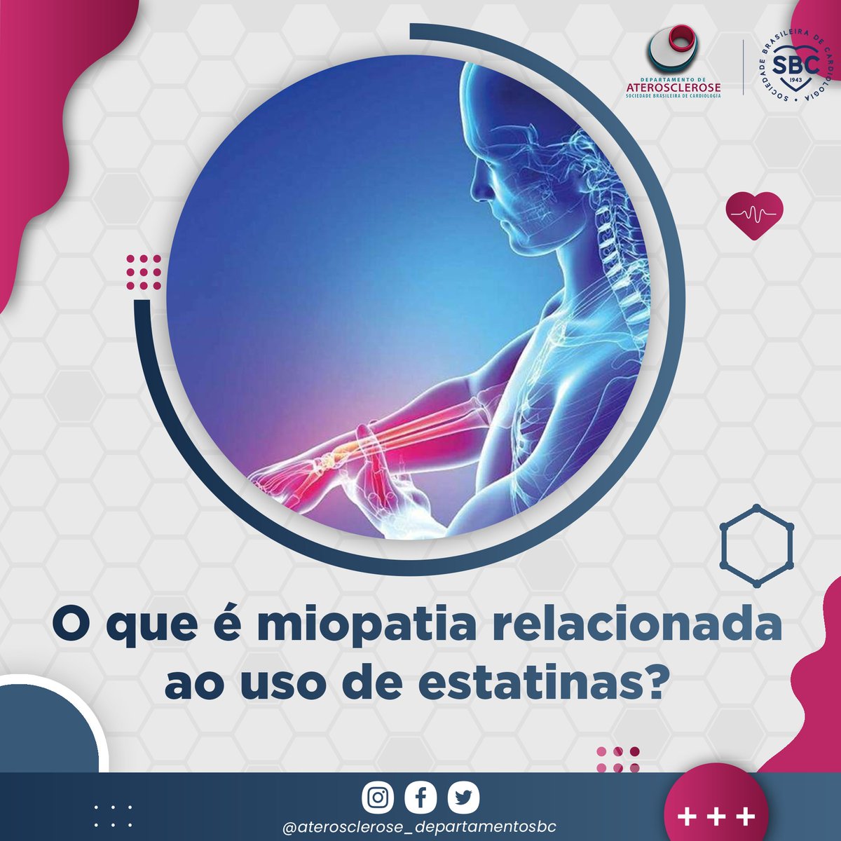 A miopatia, ou SMRE 3, ocorre quando há elevação entre 7-10 vezes o valor de referência da cpk. Ela afeta cada 5-100.000 pacientes/ano. #sbcda #aterosclerose #dislipidemia #enquetes #metanalise #estatina