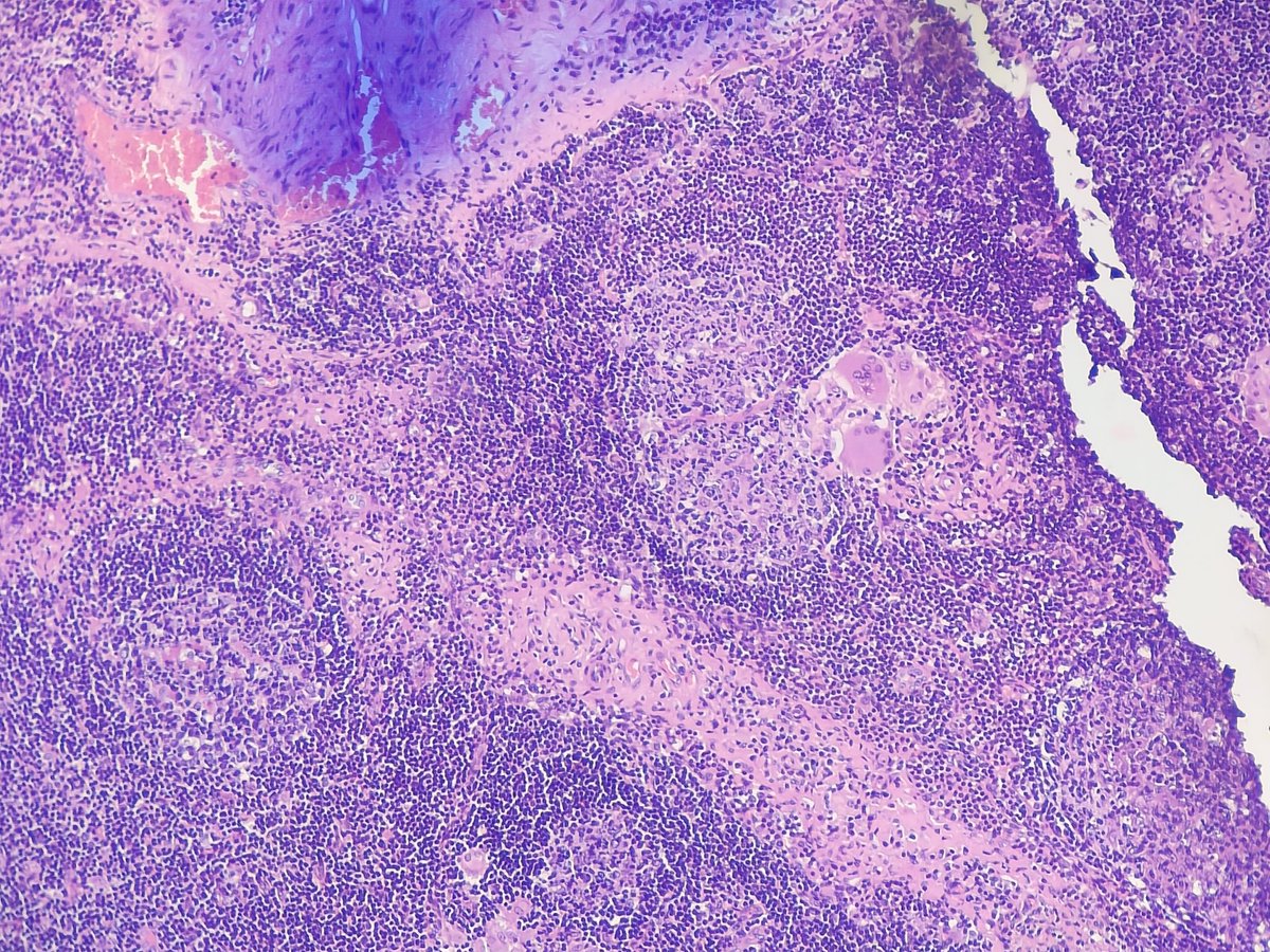 Swathiprabhu5's tweet photo. I was searching if I could find any tumour mets
Instead found this in a lymph node https://t.co/KOmqEFfORT