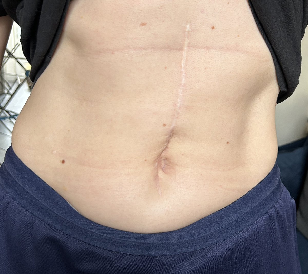 emilyjmacaulay's tweet photo. Five years ago today I had a liver resection. That was all #NHS75 and I celebrate every one of them this #NHS75birthday weekend.
(My liver is fully grown back and doing grand things, and my scar is looking fab #ChicksDigScars). https://t.co/oyF8LWrEFc
