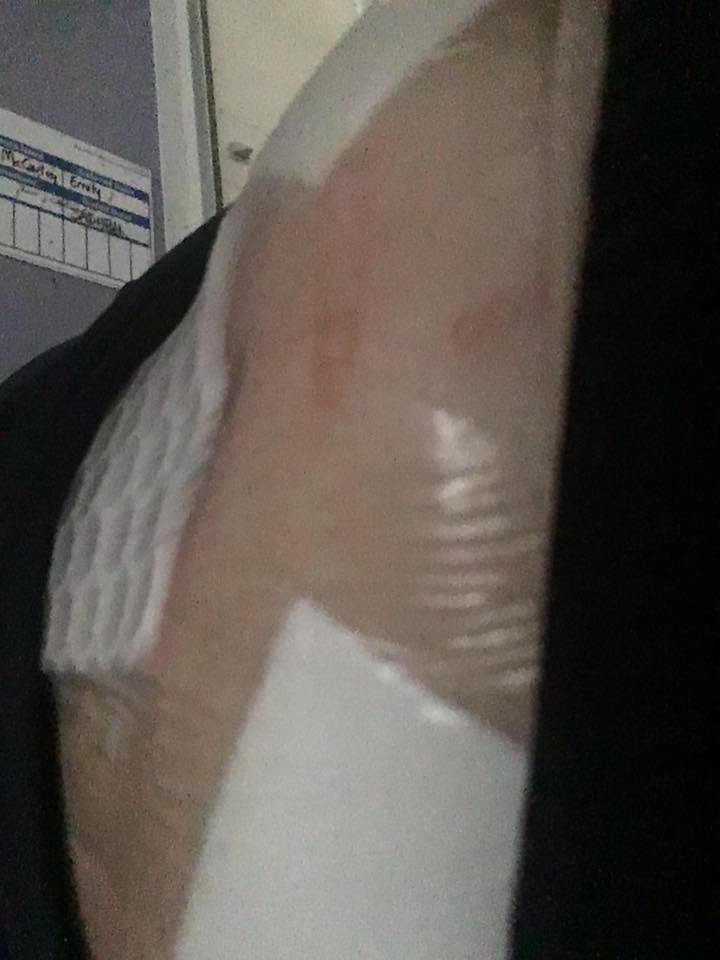 emilyjmacaulay's tweet photo. Five years ago today I had a liver resection. That was all #NHS75 and I celebrate every one of them this #NHS75birthday weekend.
(My liver is fully grown back and doing grand things, and my scar is looking fab #ChicksDigScars). https://t.co/oyF8LWrEFc