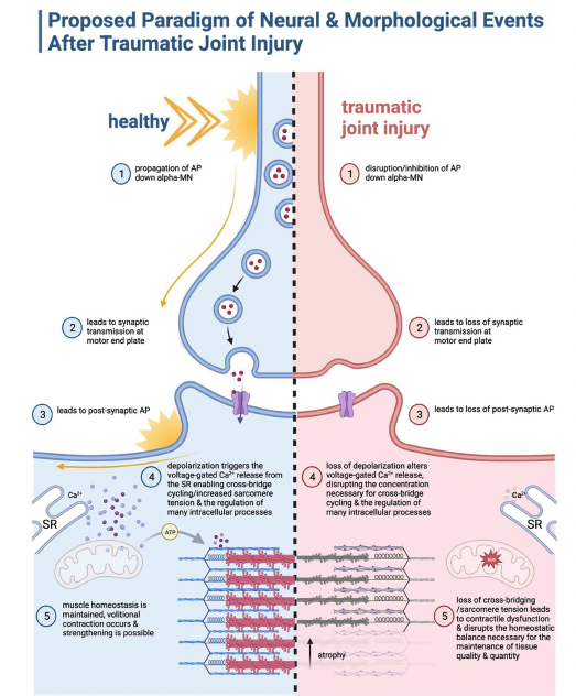 a_bricca's tweet photo. Eccentric Exercise as a Potent Prescription for Muscle Weakness After Joint #Injury

An approach that can stimulate the body's systems to enhance muscle growth, despite the numerous factors contributing to the deterioration of muscle health

🧵Hypothesis

https://t.co/BHWdoAjLgu https://t.co/5K0FaCDPQs