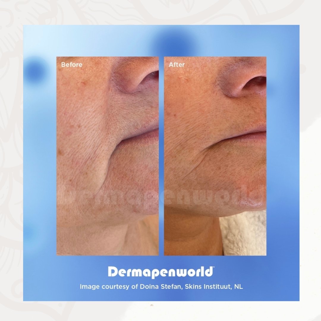 bodybarn's tweet image. Experience amazing skin with the extraordinary combination of MG-EXO-SKIN™ and Dermapen Treatment™. Check out the difference! ✨🧬 #ExosomeTherapy #DermapenTreatment #AmazingSkin