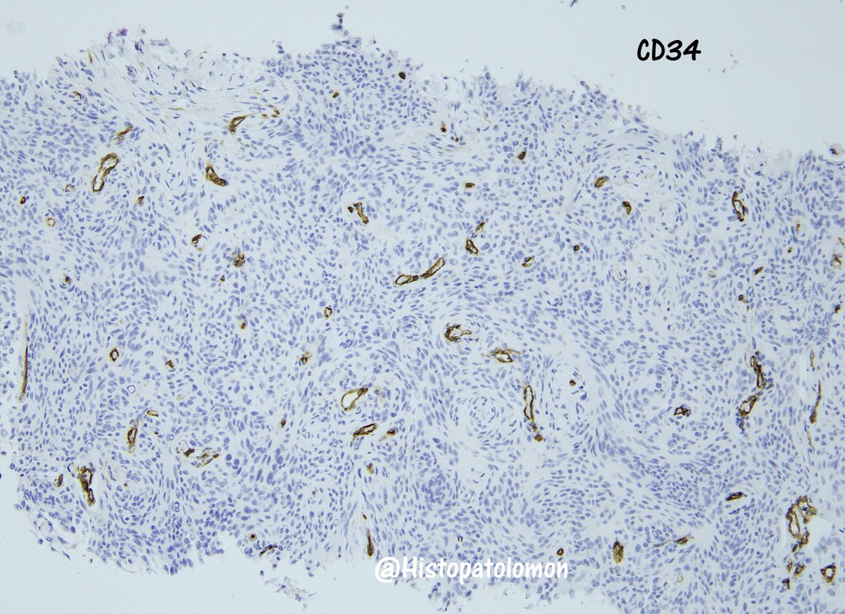 @lara_pijuan @yro854 @smlungpathguy @SansanoValero @tlabiano @nucleololailo @natasharekhtman @PoloniaAntonio @TristanRutland7 @MAHoureih The relevant immunohistochemistry of the case. Also negativity for CK and positivity for Vimentin 
#IHCPath #ihcEMA #ihcProgesteroneR #SurgPath #meningioma #Lungpath #pulmpath #lungtumor 
#lungmeningioma #extracranialmeningioma
#primarylungmeningioma #pathology #pathologists