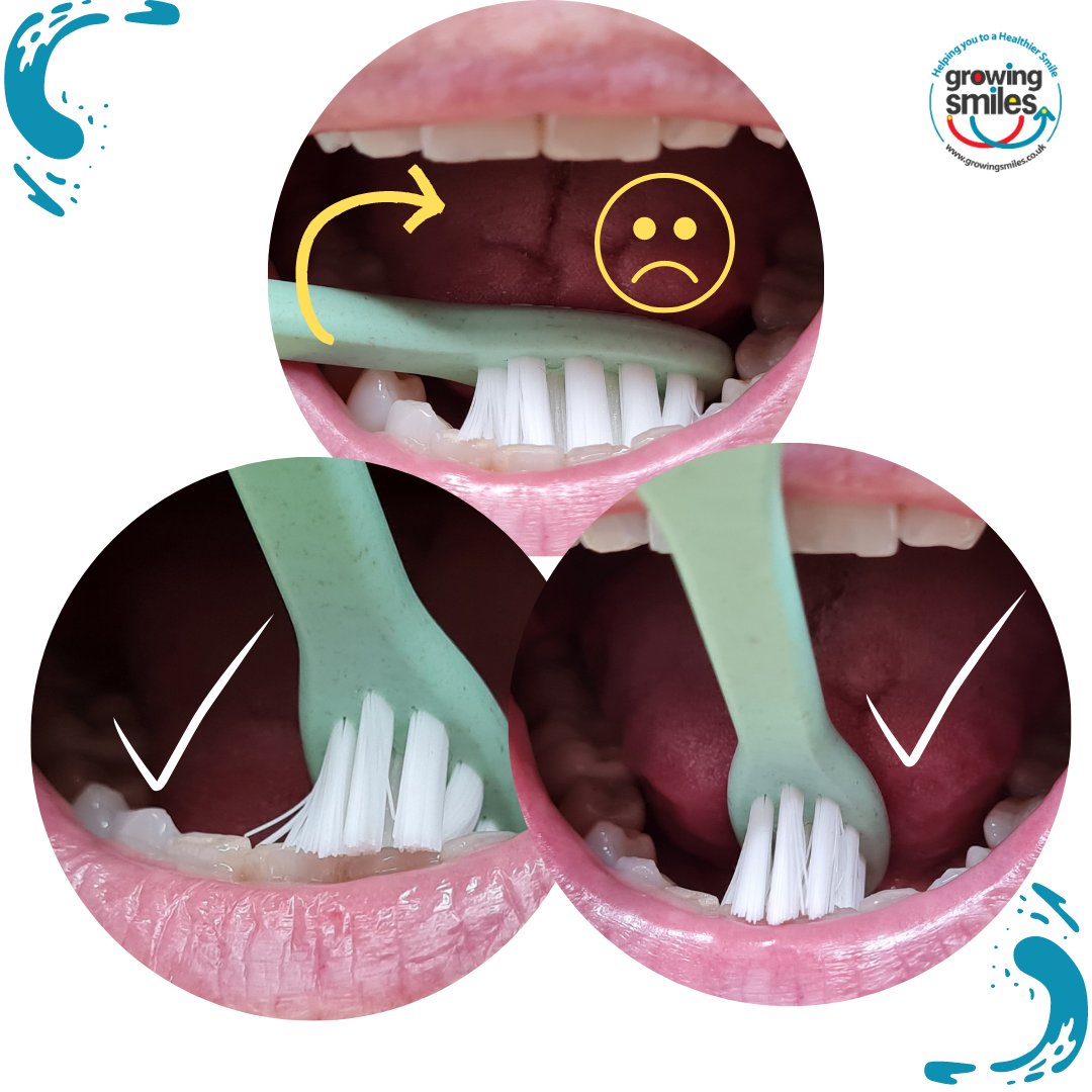growingsmilesuk's tweet photo. HOW to reach behind front teeth? Instead of holding your toothbrush horizontally, turn it vertically. Not sure if you are where you need to be? #plaqueremoval #tartarcontrol #cleanteeth #toothbrushing #toothbrush #oralhygiene #dentalhygiene #oralhealth #dentalhealth https://t.co/5NsNKVHBqi