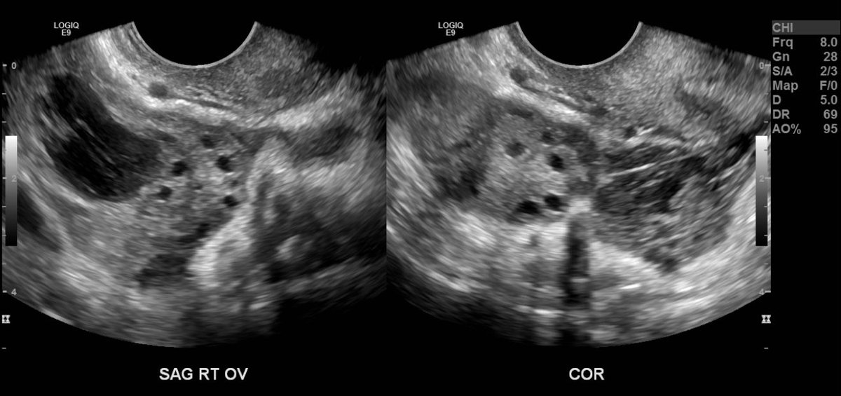 MetroRadRes's tweet image. Interesting case from Metrohealth archives! Ruptured tubal ectopic pregnancy with hemoperitoneum.