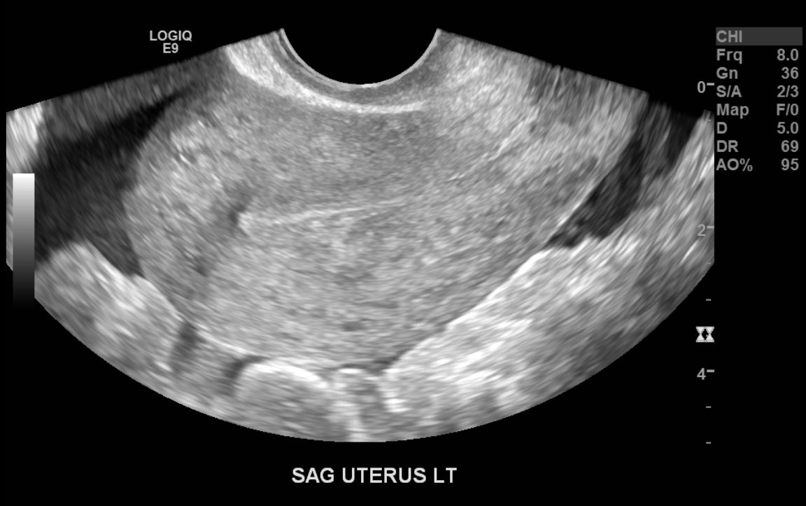MetroRadRes's tweet image. Interesting case from Metrohealth archives! Ruptured tubal ectopic pregnancy with hemoperitoneum.