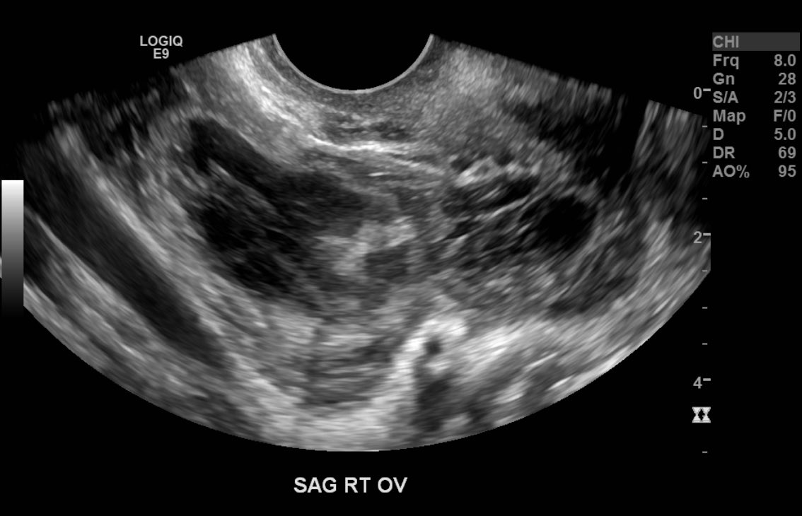 MetroRadRes's tweet image. Interesting case from Metrohealth archives! Ruptured tubal ectopic pregnancy with hemoperitoneum.