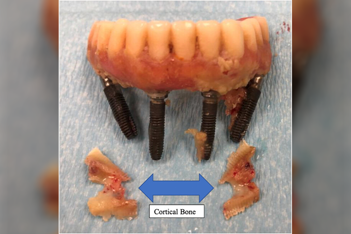 Now online in the <a href="/joprosthodont/">Journal of Prosthodontics</a>, a new case report co-authored by ACP member Dr. Thomas J. Balshi.

This article describes how the use of a continuous positive airway pressure (CPAP) machine may be a risk factor in implant dentistry.
