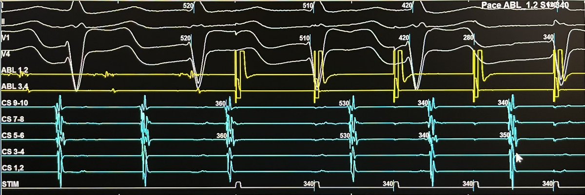 At first I was frustrated that the atypical flutter terminated with entrainment attempt, but went back to see how it terminated. #EPeeps