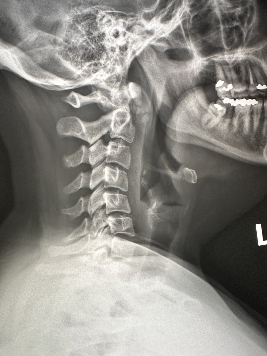 Hot seat case….30 yof. Non traumatic neck pain