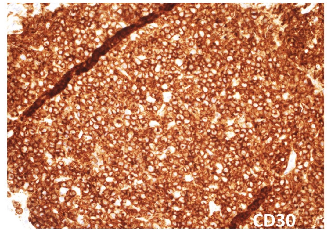 63/male with abdominal lymphadenopathy. DQ gave the initial clue to hemepath diagnosis. Positive CD3/5/7/25. CD30 diffuse, ALK1/CD20 negative. CD30+ Mature T-cell lymphoma. D/D ALCL or ATLL 
HTLV1 is positive!
#cyto #hemepath #PathTwitter <a href="/kkuanMD/">Kevin Kuan</a> <a href="/YanhuaWang3/">Yanhua Wang</a> #bridgingcytoheme