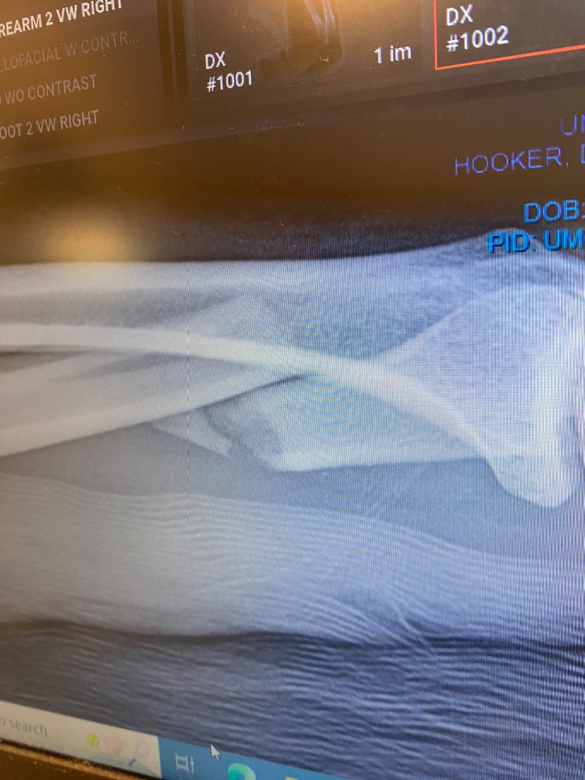 arielhelwani's tweet photo. Dan Hooker suffered a broken orbital bone and a broken arm during his fight on Saturday night. Here are the X-Rays, courtesy of Hooker. https://t.co/pyWLd17pw7