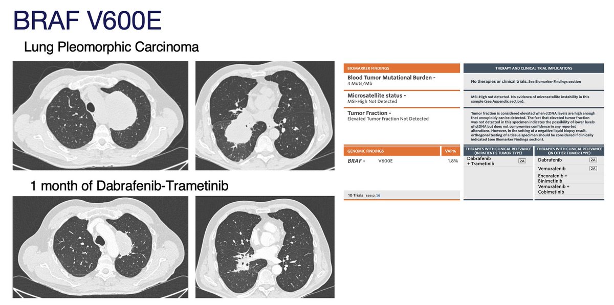 #tumoragnostic approvals can change the life of patients with oncogenic-driven cancers. 66 y/o male, never smoker with stage IV lung pleomorphic carcinoma was offered doxorubicin as a 1L tx. Plasma NGS detected #BRAF V600E mutation. Just 1 month of #dabrafenib + #trametinib !👇🏽